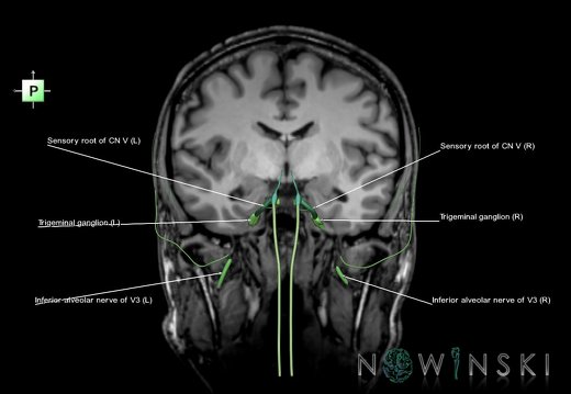 G6.T19.8.V3.P-09S.Trigeminal nerve–Triplanar