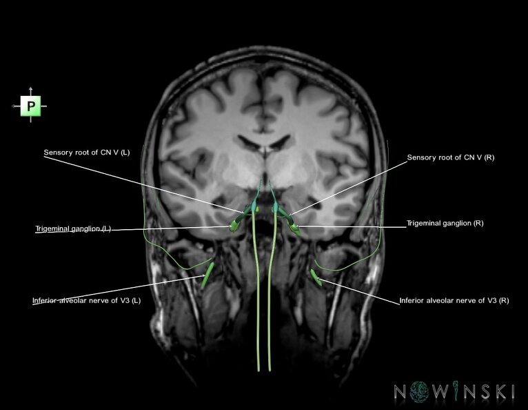 G6.T19.8.V3.P-09S.Trigeminal_nerve–Triplanar.tiff