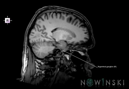 G6.T19.8.V4.P-18.Trigeminal nerve–Triplanar