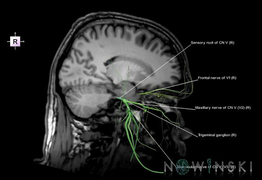 G6.T19.8.V4.P-18S.Trigeminal nerve–Triplanar