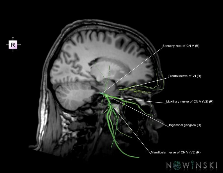 G6.T19.8.V4.P-18S.Trigeminal_nerve–Triplanar.tiff