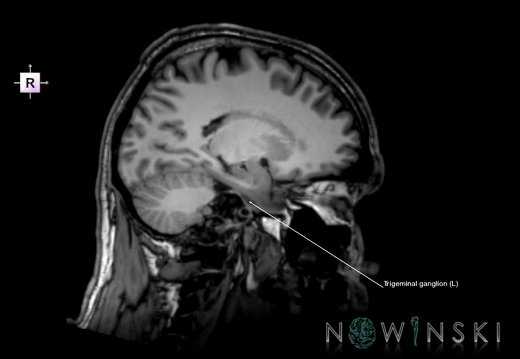 G6.T19.8.V4.P20.Trigeminal nerve left–Triplanar