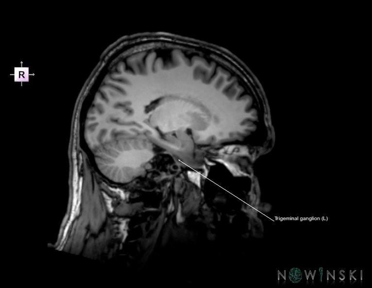 G6.T19.8.V4.P20.Trigeminal_nerve_left–Triplanar.tiff