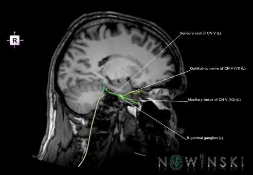 G6.T19.8.V4.P20S.Trigeminal nerve left–Triplanar