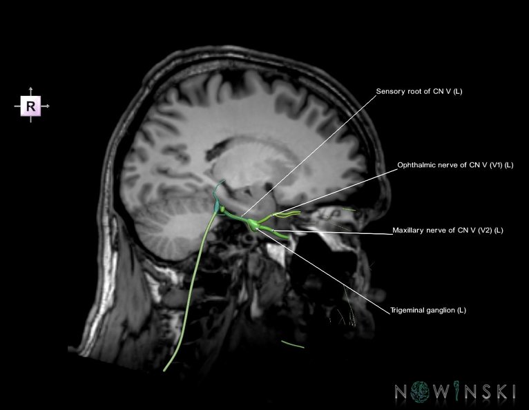 G6.T19.8.V4.P20S.Trigeminal_nerve_left–Triplanar.tiff