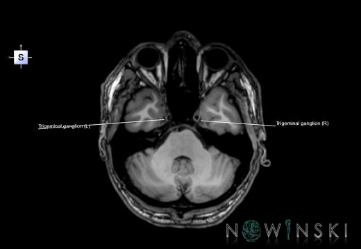 G6.T19.8.V5.P-32.Trigeminal nerve–Triplanar