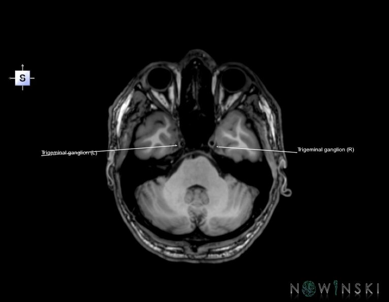 G6.T19.8.V5.P-32.Trigeminal_nerve–Triplanar.tiff