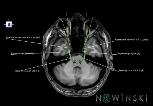 G6.T19.8.V5.P-32S.Trigeminal nerve–Triplanar