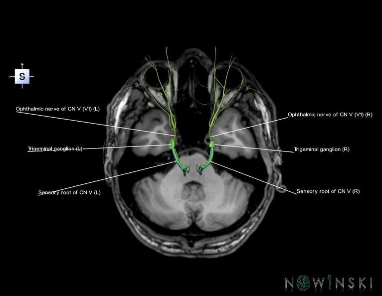 G6.T19.8.V5.P-32S.Trigeminal_nerve–Triplanar.tiff