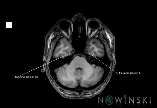 G6.T19.8.V6.P-32.Trigeminal nerve–Triplanar