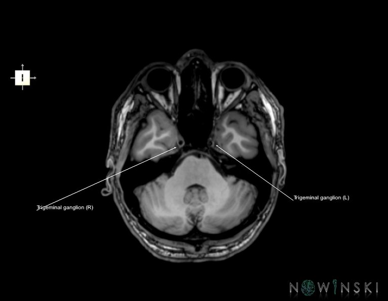 G6.T19.8.V6.P-32.Trigeminal_nerve–Triplanar.tiff