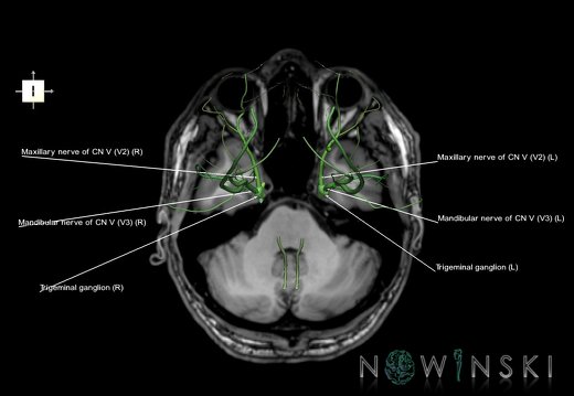 G6.T19.8.V6.P-32S.Trigeminal nerve–Triplanar