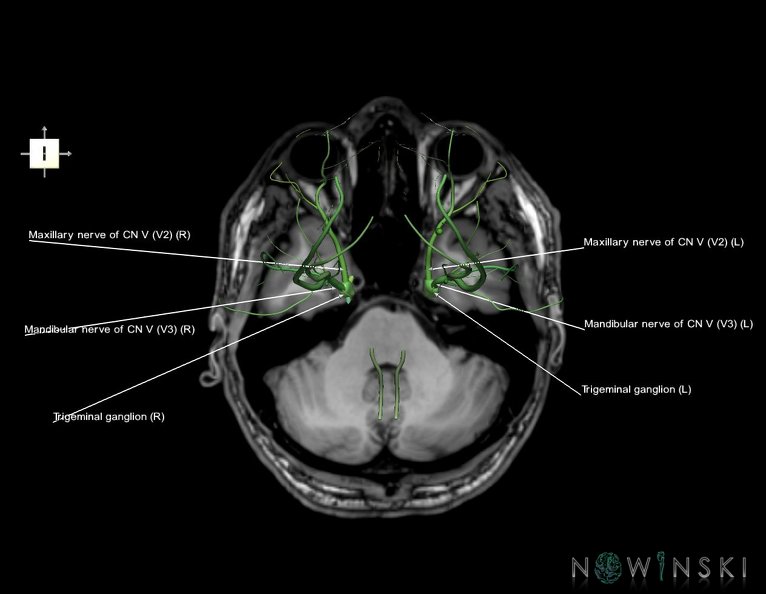 G6.T19.8.V6.P-32S.Trigeminal_nerve–Triplanar.tiff