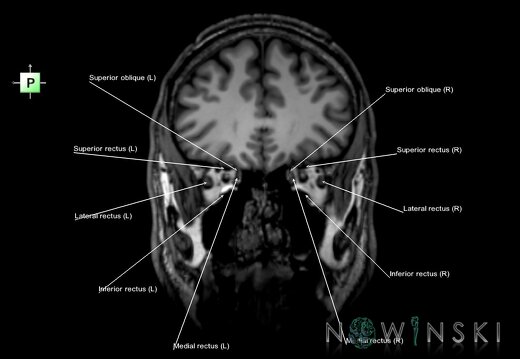 G6.T20.4.V3.P30.Extraocular muscles–Triplanar