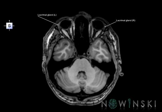 G6.T21.V5.P-30.Glands–Triplanar