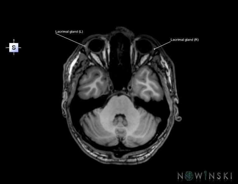 G6.T21.V5.P-30.Glands–Triplanar.tiff