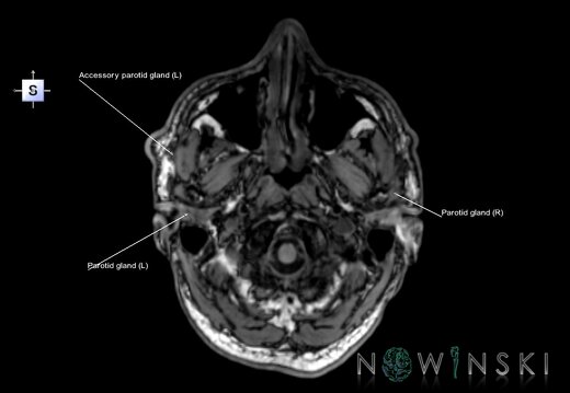 G6.T21.V5.P-60.Glands–Triplanar