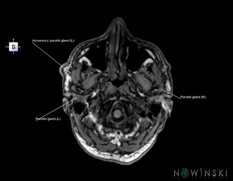 G6.T21.V5.P-60.Glands–Triplanar.tiff