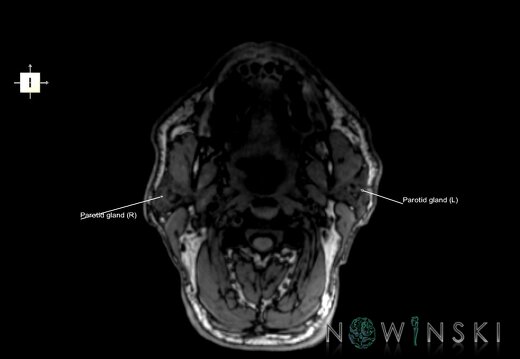 G6.T21.V6.P-100.Glands–Triplanar