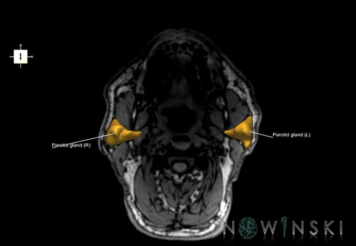 G6.T21.V6.P-100S.Glands–Triplanar