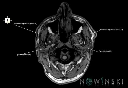 G6.T21.V6.P-70.Glands–Triplanar