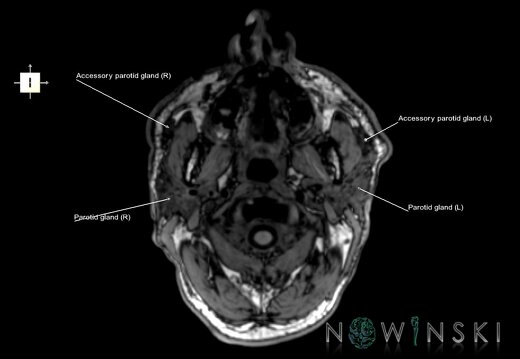 G6.T21.V6.P-80.Glands–Triplanar