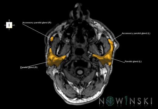 G6.T21.V6.P-80S.Glands–Triplanar