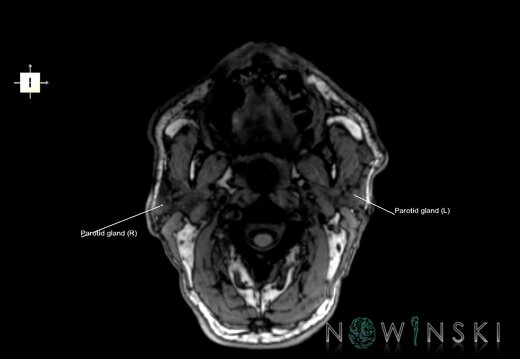 G6.T21.V6.P-90.Glands–Triplanar