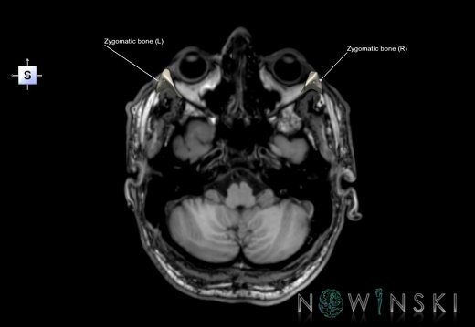 G6T22.5.10.ZygomaticBone–Triplanar