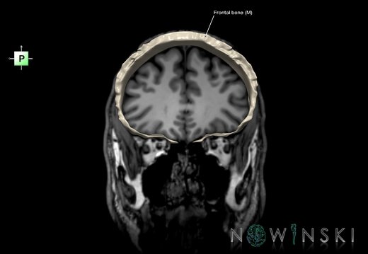 G6.T22.5.3.V4.P30S.Frontal bone–Triplanar