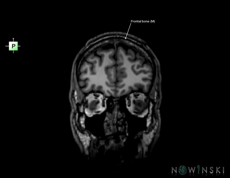 G6.T22.5.3.V4.P40.Frontal_bone–Triplanar.tiff