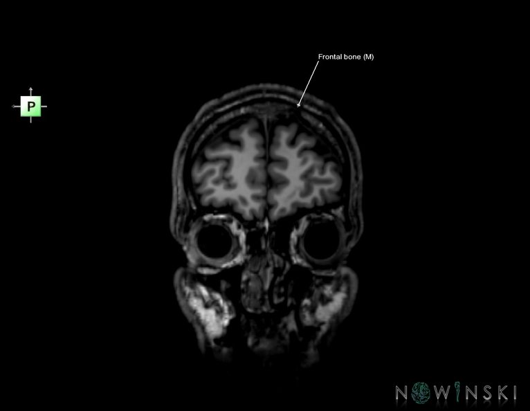 G6.T22.5.3.V4.P50.Frontal_bone–Triplanar.tiff