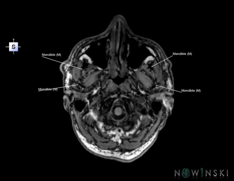 G6.T22.5.4.V5.P-60.Mandible–Triplanar.tiff