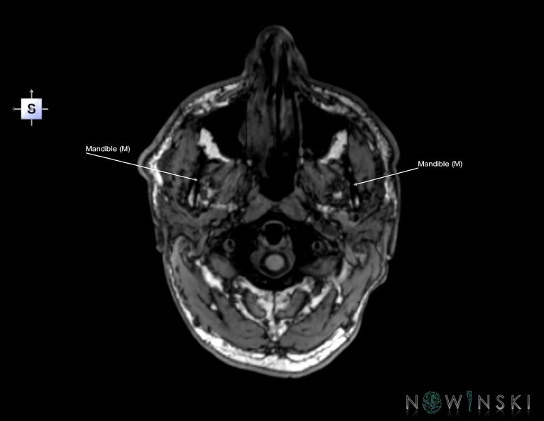 G6.T22.5.4.V5.P-70.Mandible–Triplanar.tiff