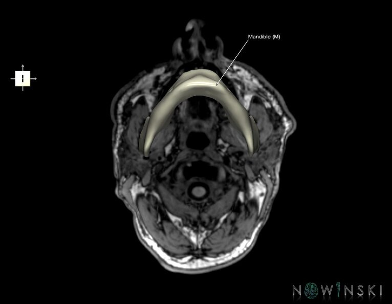 G6.T22.5.4.V6.P-80S.Mandible–Triplanar.tiff