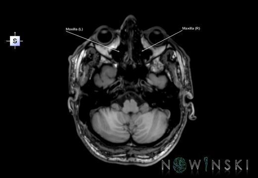 G6.T22.5.5.V5.P-40.Maxilla–Triplanar