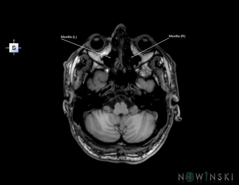 G6.T22.5.5.V5.P-40.Maxilla–Triplanar.tiff