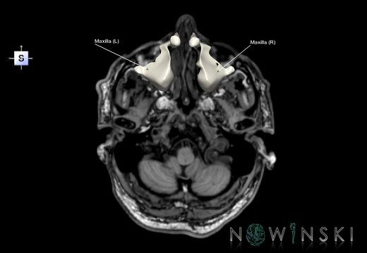 G6.T22.5.5.V5.P-50S.Maxilla–Triplanar