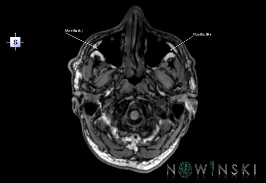 G6.T22.5.5.V5.P-60.Maxilla–Triplanar