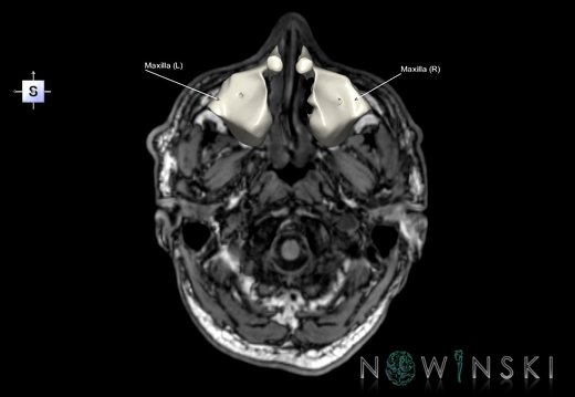 G6.T22.5.5.V5.P-60S.Maxilla–Triplanar