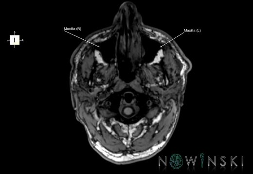 G6.T22.5.5.V6.P-70.Maxilla–Triplanar