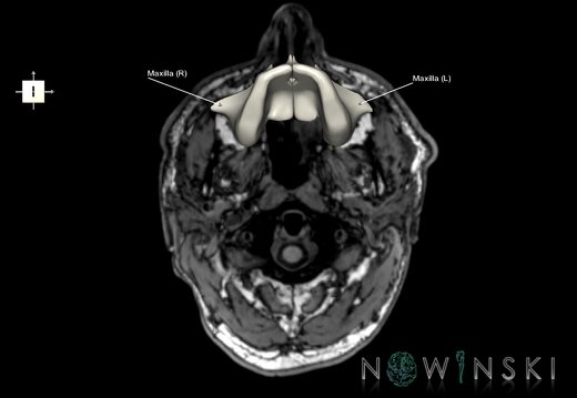 G6.T22.5.5.V6.P-70S.Maxilla–Triplanar