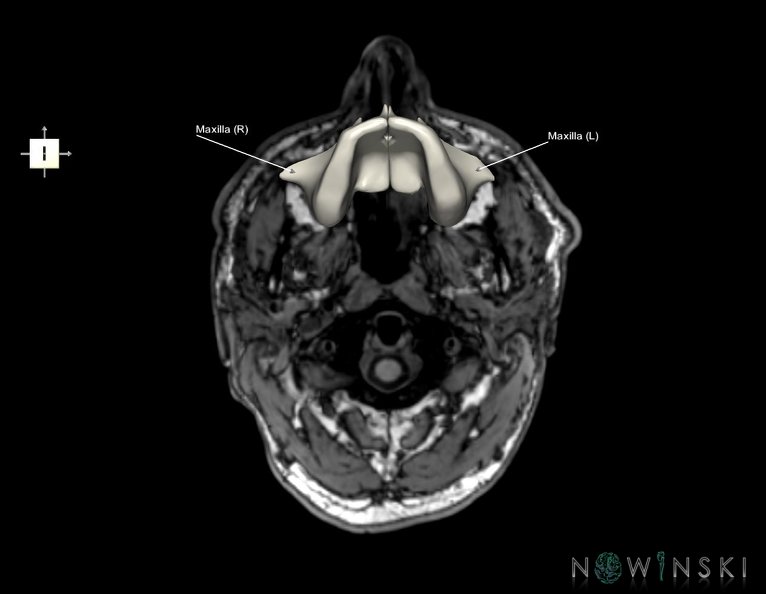 G6.T22.5.5.V6.P-70S.Maxilla–Triplanar.tiff