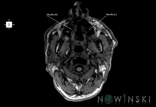 G6.T22.5.5.V6.P-80.Maxilla–Triplanar