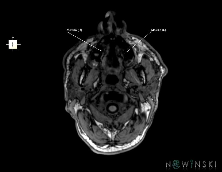 G6.T22.5.5.V6.P-80.Maxilla–Triplanar.tiff