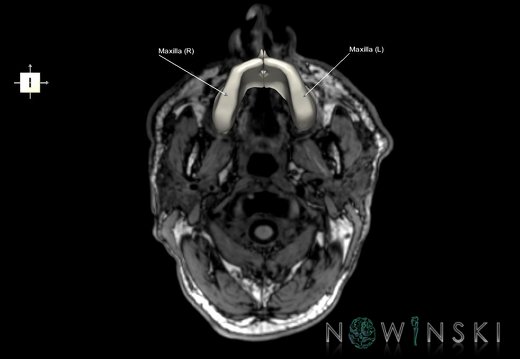 G6.T22.5.5.V6.P-80S.Maxilla–Triplanar