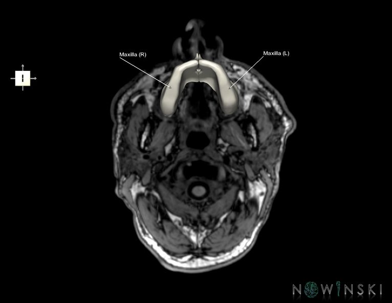 G6.T22.5.5.V6.P-80S.Maxilla–Triplanar.tiff