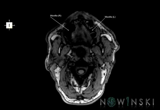 G6.T22.5.5.V6.P-90.Maxilla–Triplanar