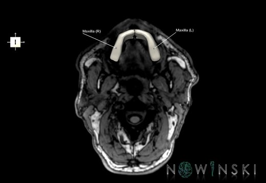 G6.T22.5.5.V6.P-90S.Maxilla–Triplanar