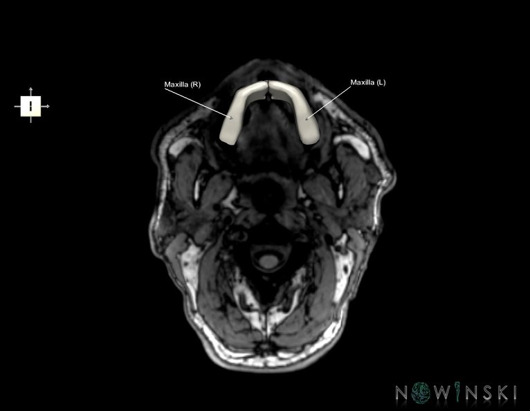 G6.T22.5.5.V6.P-90S.Maxilla–Triplanar.tiff